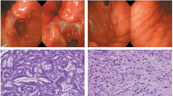 장형 위암(왼쪽)과 미만형 위암(오른쪽)의 내시경 사진(위) 및 현미경 사진(아래).